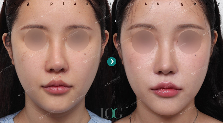 治療前・治療後