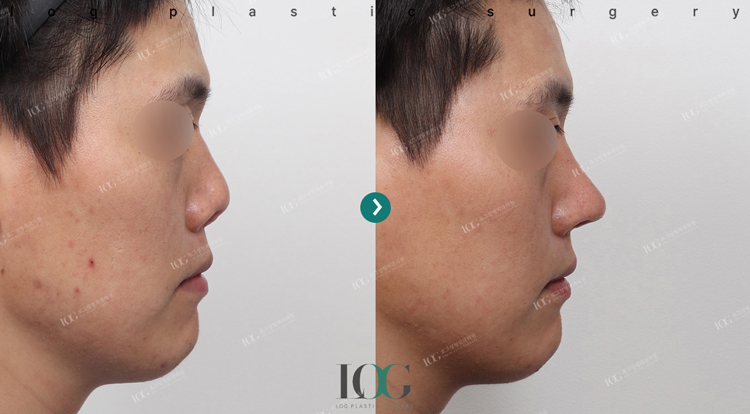 治療前・治療後