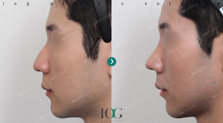 治療前・治療後